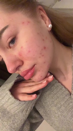 Happy Maus 🥰 #akne #aknederm #clearskin #fyp #viralvideos