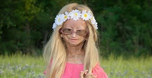 Adalia Rose: Unusual Story of a Girl Who Ages Too Fast