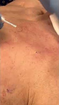 Satisfying Mole Removal