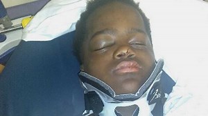Student has facial, head injuries after fall from school balcony