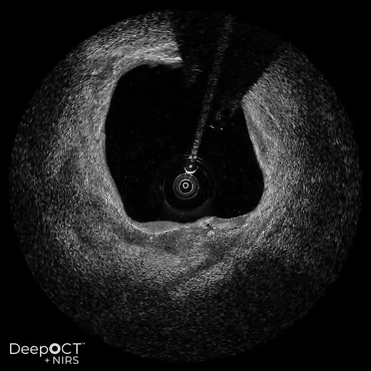DeepOCT+NIRS Imaging of Calcified Plaque