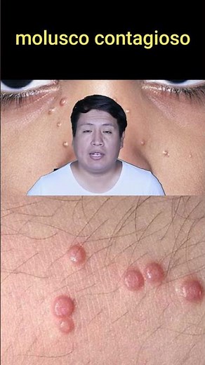 Signos y síntomas del molusco contagioso