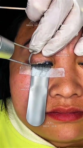 #beauty #skincare #laser #facial #glowingskin #aesthetic #viral #skin #clinic #treatment #skincare