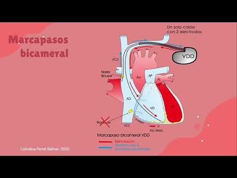 Implantes de marcapasos, cuidados y complicaciones