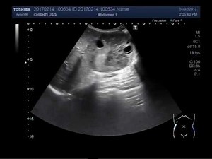 Ultrasound Video showing large renal Angiomyolipoma.