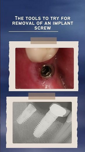 The tools to try for removal of an implant screw...