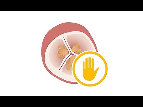 Prophylactic antibiotic treatment to prevent infective endocarditis
