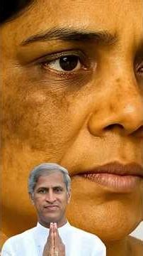 ఫిగ్మెంటేషన్ మచ్చలు పోవడానికి మంతెన గారు చెప్పిన సీక్రెట్🔥