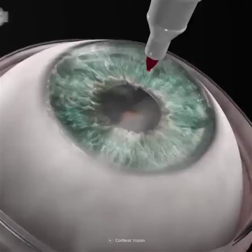 A New Vision: The Future of Cornea TransplantsA Breakthrough in Medical ScienceCorneal blindness, a condition that affects millions worldwide, has long been a challenging medical problem… | Building Sustainable Model