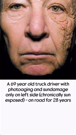 Importantance of sunscreen to neck and ears.