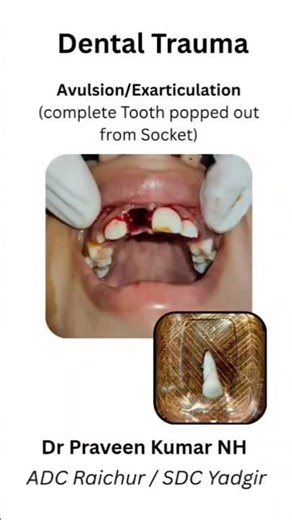What to Do If a Permanent Tooth Is Knocked Out (Dental Avulsion treatment)