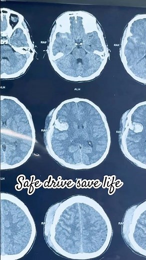 Induction of Anaesthesia in Contusion Head Injury | Safe Cranioplasty Repair Protocol