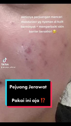 Kulit bruntusan jerawat parah & bekas jerawat merah & kehitaman pakai moisturizer ini aja 💙😘 #moisturizer #acne #skincarejerawat