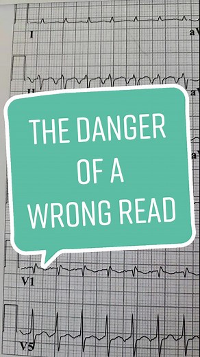 atrial tachycardia mistaken for atrial flutter #ecg #ekg #cardiology | EKG