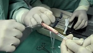 All-Inside ACL Reconstruction with Quadrupled Semitendinosus with ToggleLoc and ToggleLoc XL