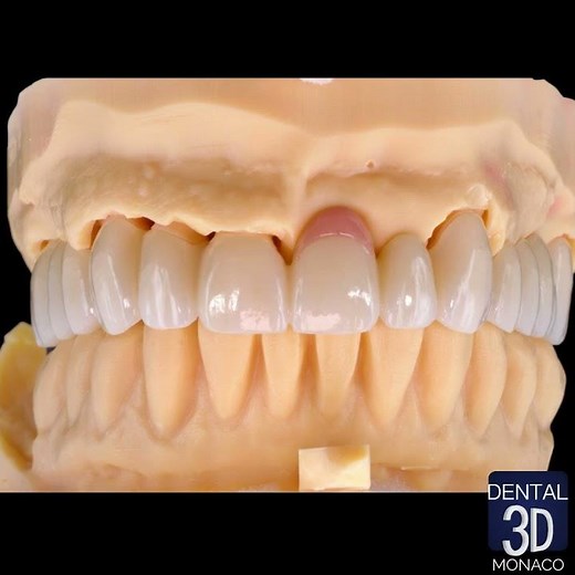 Bridge complet Multilayer #3shape #d3dcandoit #dentalcaddesign
