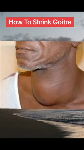 Effective Herbal Remedies to Shrink Goiter Naturally