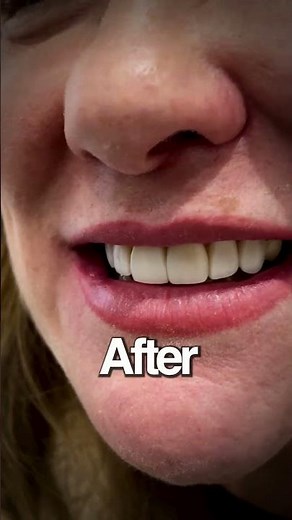 10 Teeth Composite Veneers Before and After | Full Smile Transformation