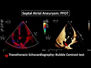 Atrial Septal Aneurysm: PFO? Transthoracic Echocardiography: Buble Contrast Test 2D, 3D