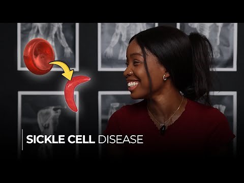 Sickle Cell Disease: Understanding the Causes, Symptoms, and Sickle Cell Crisis