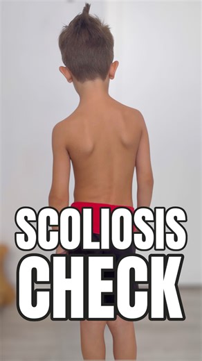 Marco Rovatti on Instagram: "Identifying Scoliosis in Children: A Simple Screening Guide In this video, we discuss how to check if your child has scoliosis. We explain the steps to observe their shoulders, pelvis, and spine for any curves, as well as how to perform the forward bend test both standing and seated. We emphasize the importance of consulting a spine specialist if the results are unclear or concerning. @rovattiplan #scoliosis #scoliosiswarrior #scoliosissurgery #scoliosi #escoliosis #