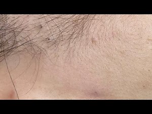 Deep & Relaxing Acne Removal with Linh Mydang #565 P2