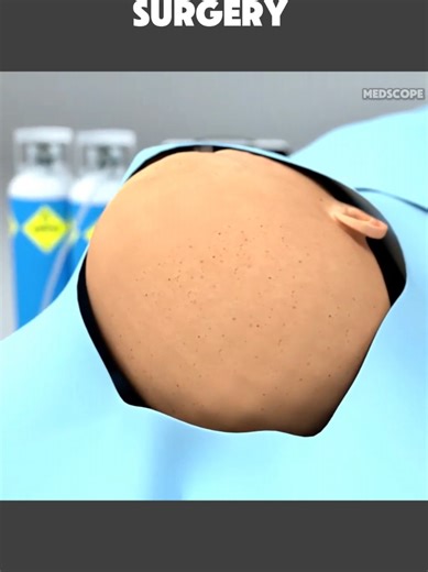 How Craniotomy Brain Surgery Is Done (3D Animation) #medicalanimation #3dmedicalanimation #medical3danimation #brainsurgery #craniotomy