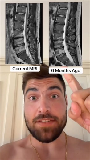 MRI Normal But Still Have Back Pain? Here's Why!