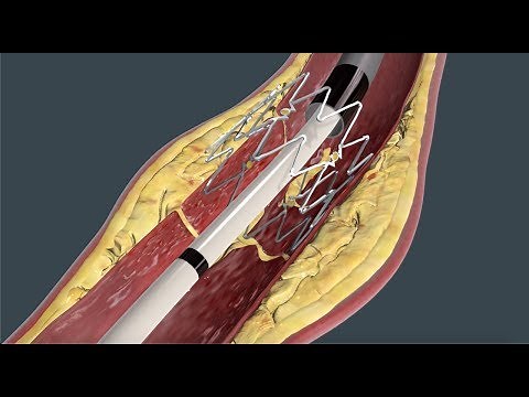 Tack Endovascular System® mechanism of action (MOA)
