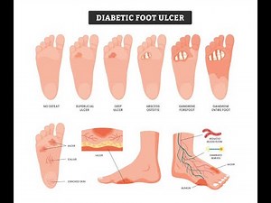 Wagner’s classification of diabetic foot Ulcer lesions