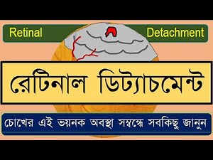 Retinal detachment: Symptoms, signs, and treatment.#retinaldetachment #retinaldetachmentlecture