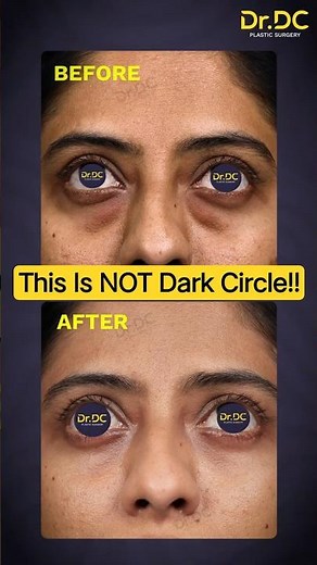 This Is NOT Dark Circles! | Eye Bags Vs Dark Circles Explained! | Dr DC, Plastic Surgeon | Pune