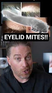 Eyelid Mites Causing Demodex Blepharitis