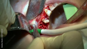 Dentist do dental check up a patient in modern office clinic operating room uses modern dental equipment and anesthesia. Close-up dental care oral and maxillofacial implant surgery.