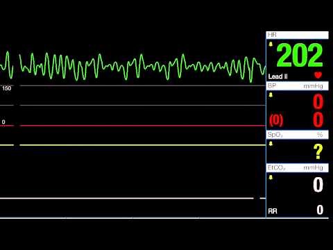 Ventricular Fibrillation - V-Fib