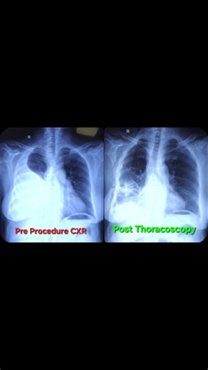 #cxr #Thoracoscopy #pleuraleffusion #radiology #aiims #neet #procedure
