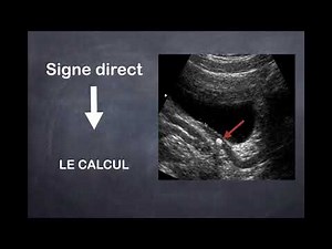 Lithiase Urinaire - 2. Diagostic positif