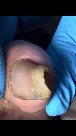 Caring for Ingrown Toenails: Tips and Remedies