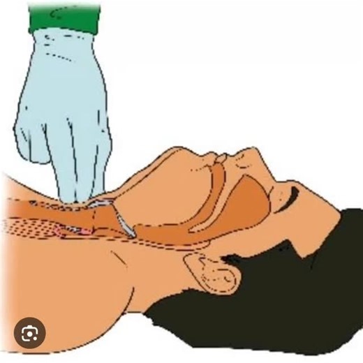 NURSING EXAM PREPARATION on Instagram: "The Sellick maneuver, also known as cricoid pressure, is a technique used during tracheal intubation to prevent regurgitation and aspiration of gastric contents by applying firm backward pressure on the cricoid cartilage to occlude the esophagus"