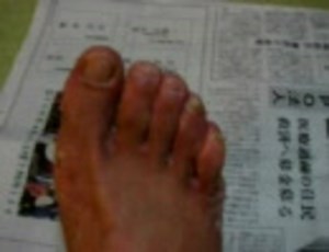 プロポリスは水虫に効くのか？　実験中です　水虫動画003