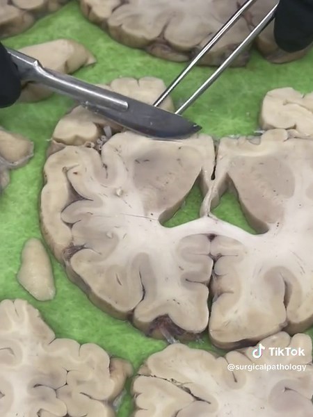 Brain tissue sampling | brain