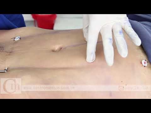 hi definition liposculpture