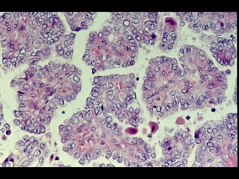 Thyroid Neoplasms - Pathology mini tutorial