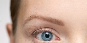 This is why freckles exist