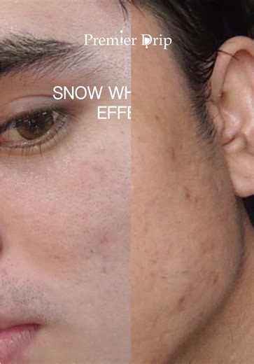 Experience the Transformative Snow White Drip Treatment