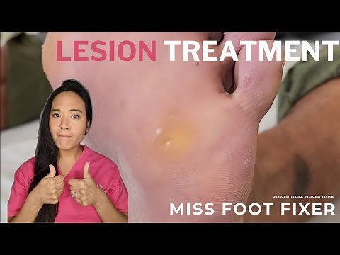 Deep Foot Lesion Treatment | Removing Painful Corns & Calluses