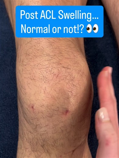 ACL Surgery Swelling: Is Your Knee Too Big?