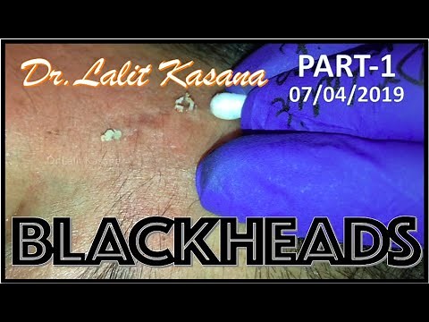 BLACKHEAD REMOVAL WITH COTTON BUDS AND EXTRACTOR PART-1 by Dr.Lalit Kasana
