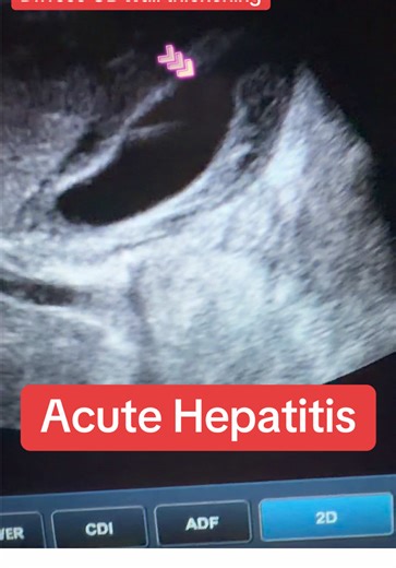 Acute Hepatitis: Ultrasound Signs Explained