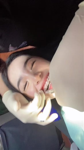 Braces Removal Mini Vlog: My Journey at the Dentist